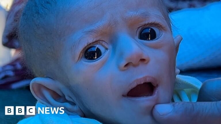 BBC returns to Gaza baby left hungry by Israeli blockade