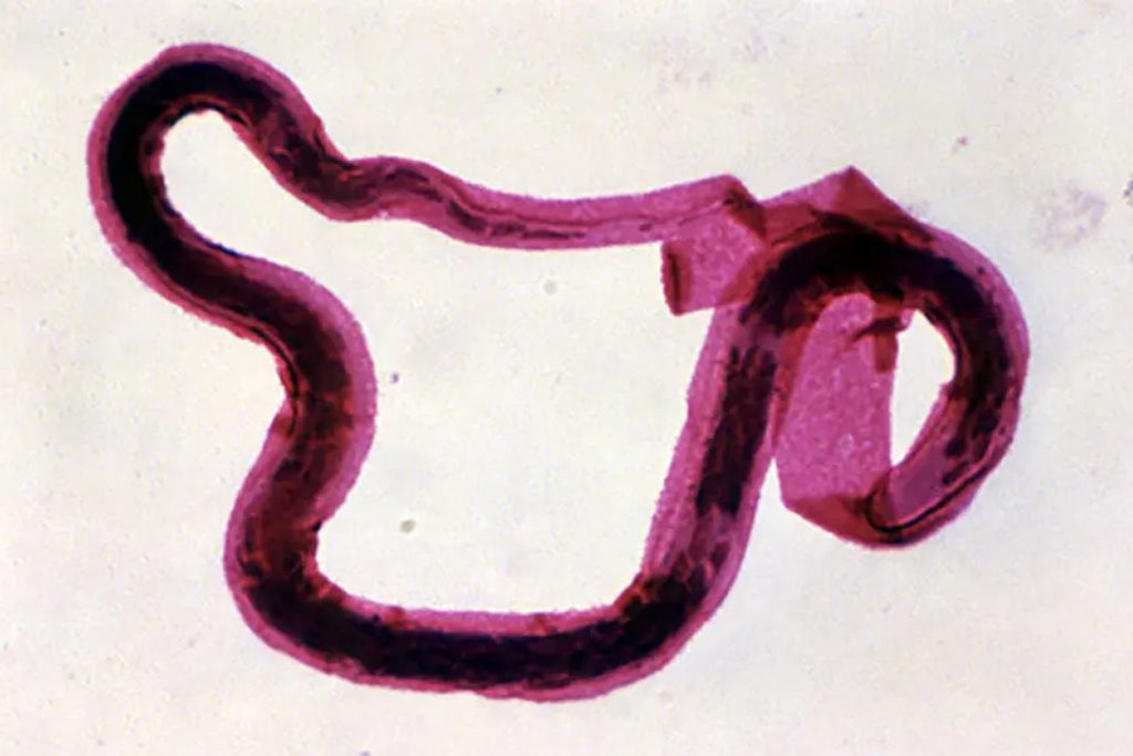 Treating elephantiasis cuts HIV risk in Tanzania